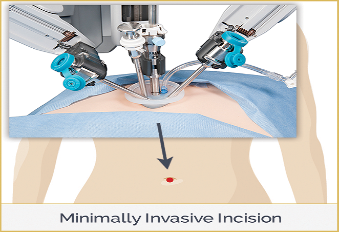 Laparoscopic Surgery